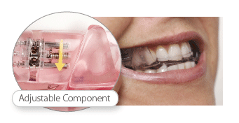 Diagram of the SomnoDent Oral Sleep Appliance